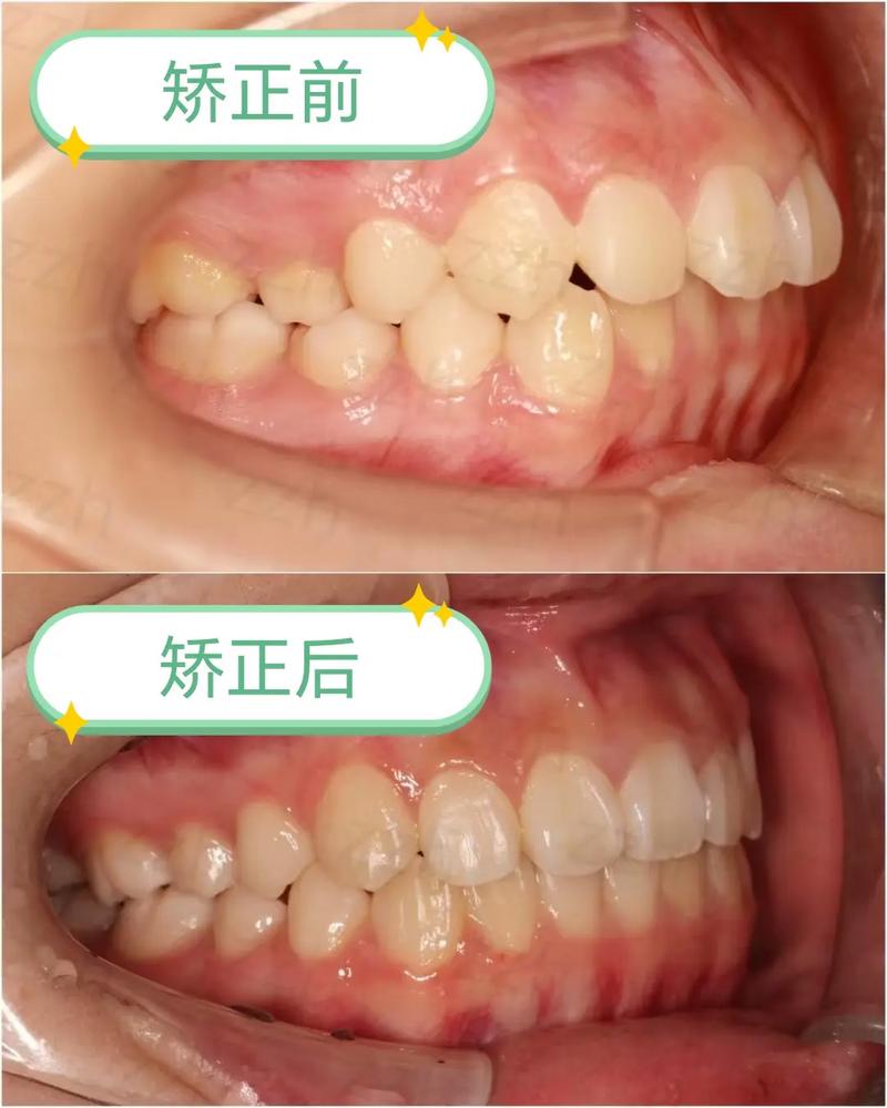 正畸前后X光对比，牙齿骨骼有何变化？-图2
