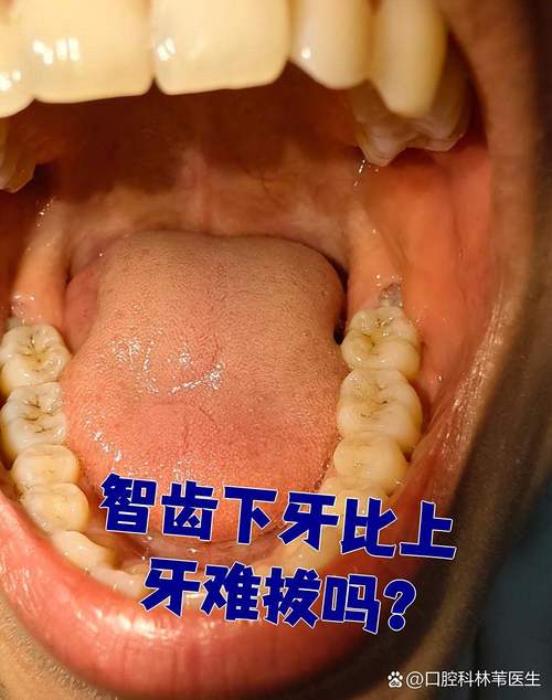 正畸时为啥能发现智齿?检查手段是什么?-图1 正畸时为啥能发现智齿?检查手段是什么?-图1