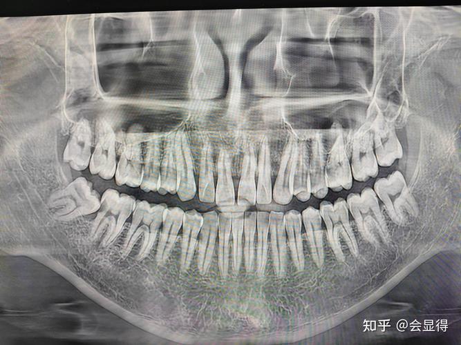 正畸时为啥能发现智齿?检查手段是什么?-图2 正畸时为啥能发现智齿?检查手段是什么?-图2