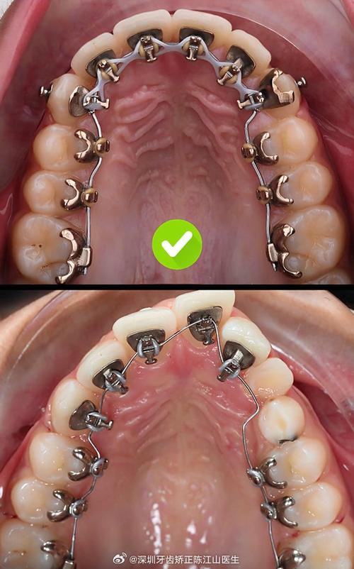 舌侧正畸多久复诊-图3 舌侧正畸多久复诊-图3
