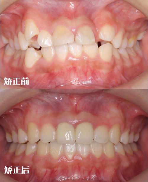 牙齿正畸后对不齐-图1