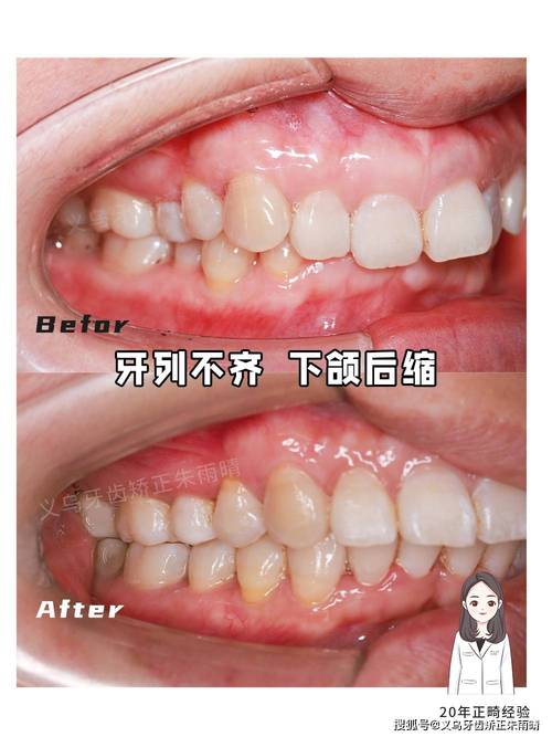 牙齿正畸后对不齐-图2