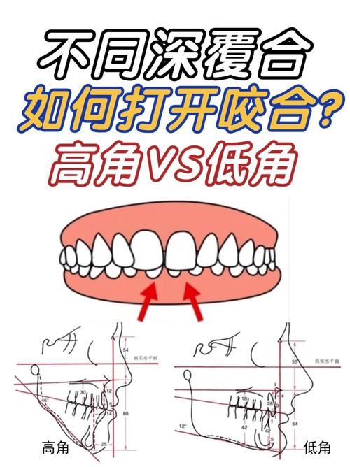 正畸高角的测量方法有哪些?步骤、标准及注意事项是什么?-图1 正畸高角的测量方法有哪些?步骤、标准及注意事项是什么?-图1