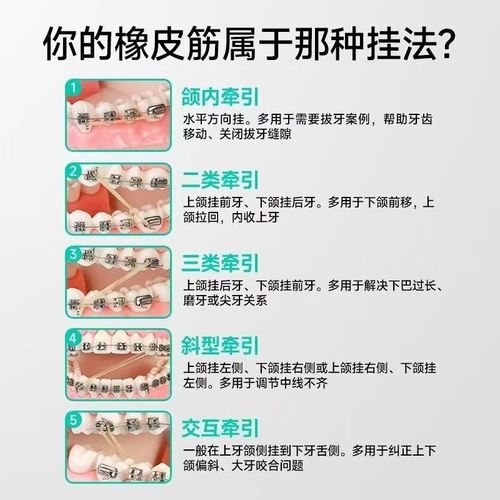 牙套正畸猴子皮筋-图2