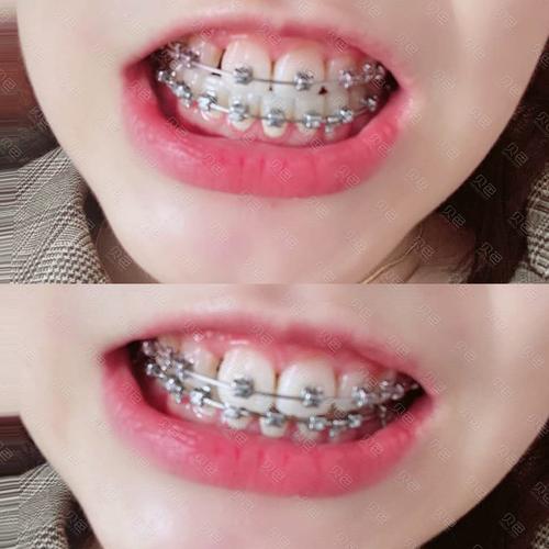 正畸牙齿下巴会歪-图3