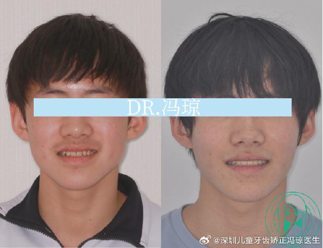 牙弓窄做不了正畸-图2