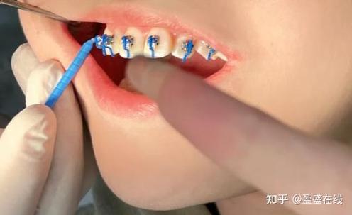 蔡斌光华正畸擅长哪些方面?-图2 蔡斌光华正畸擅长哪些方面?-图2