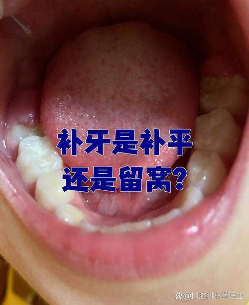 正畸前必须补牙吗-图2