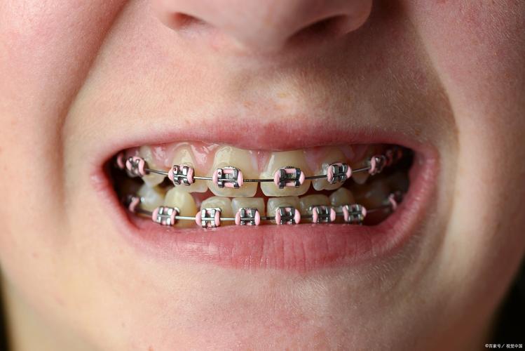 牙齿小可以正畸吗-图2