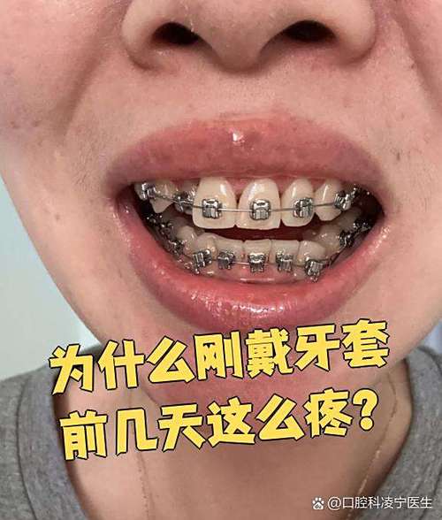 正畸牙齿加力痛吗-图3