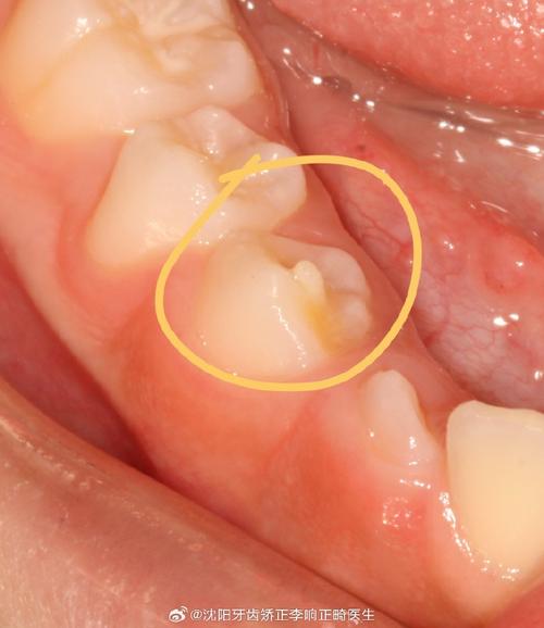 正畸尖牙牙根外凸-图1