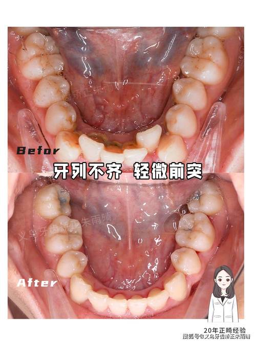 正畸尖牙牙根外凸-图3
