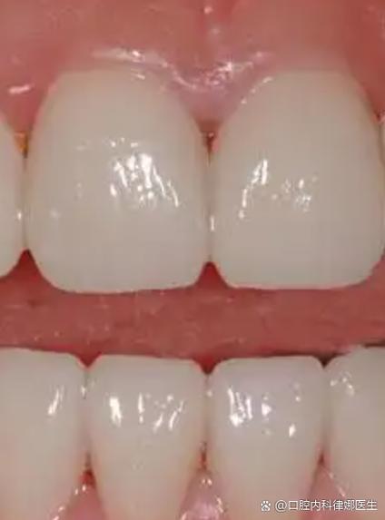 正畸牙后出现裂纹-图3