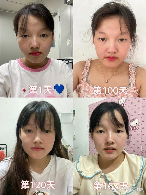 正畸治疗为何会导致颞颌关节吸收？-图2