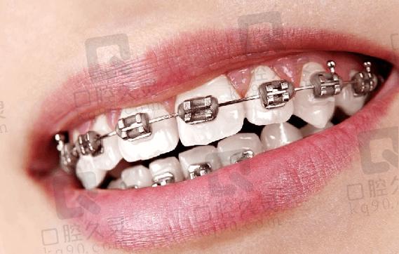 美奥口腔正畸价格-图2