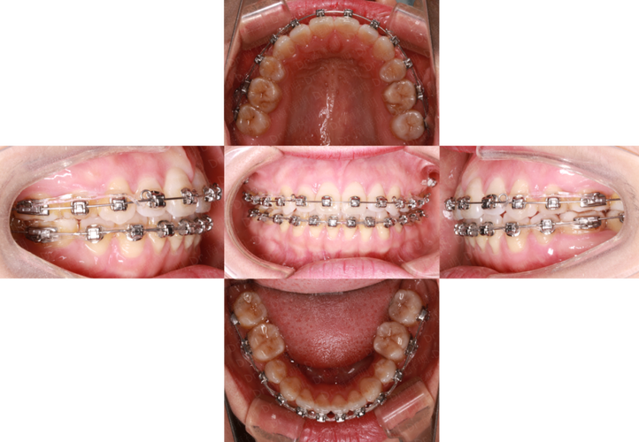 开合牙齿正畸过程-图2