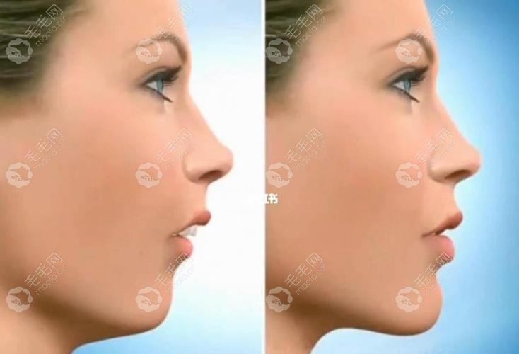 骨性龅牙正畸上颌-图3 骨性龅牙正畸上颌-图3