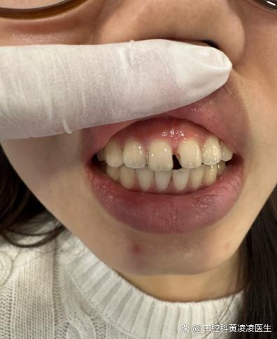 正畸大牙牙缝变大-图3