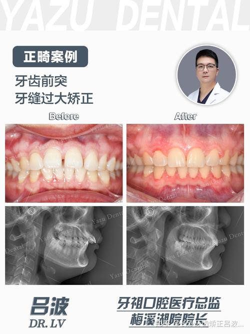 牙缝大正畸的方法-图2