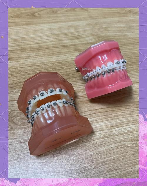 拜博口腔正畸金属-图3