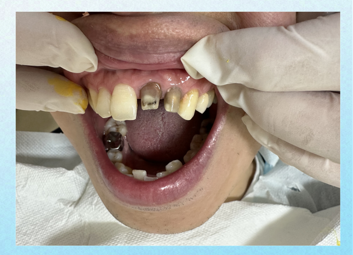 根管治疗后能正畸吗?时机与注意事项如何?-图1 根管治疗后能正畸吗?时机与注意事项如何?-图1