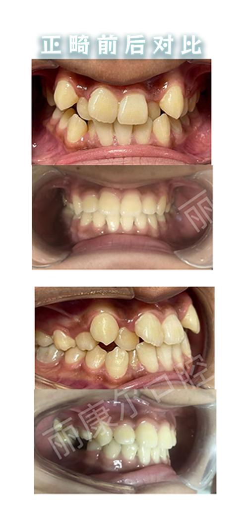 根管治疗后能正畸吗？时机与注意事项如何？-图2