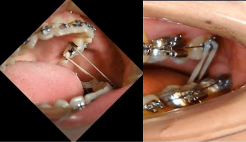 正畸牵引J钩断了怎么办？会影响矫正效果吗？-图1