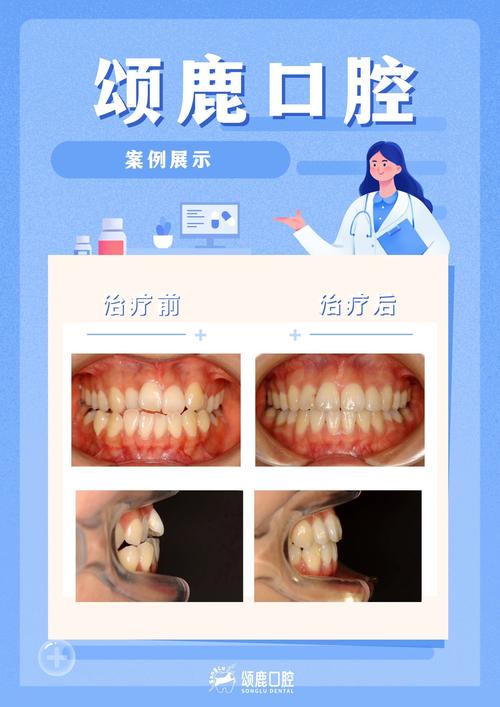 周医生正畸案例集藏着哪些牙齿矫正成功秘诀吗？-图3