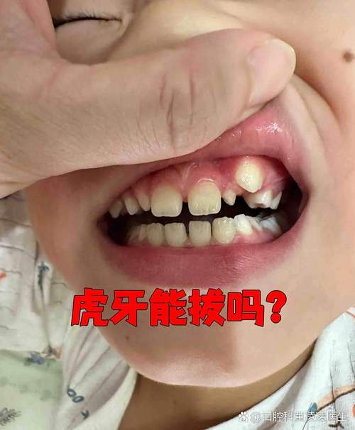 正畸虎牙到底要不要拔掉？-图2