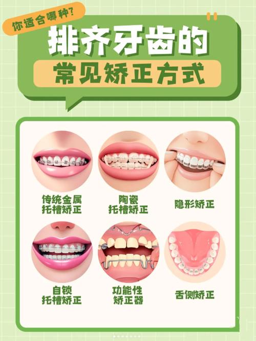 苏州哪里舌侧正畸-图2