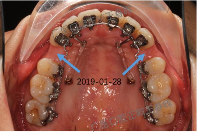 苏州哪里舌侧正畸-图3