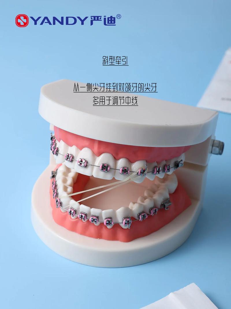 正畸牵引线是什么？矫正牙齿时它有何作用？-图1
