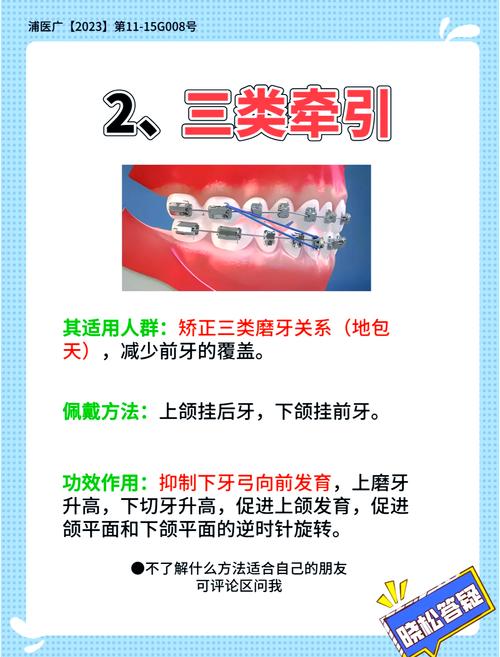 正畸牵引线是什么？矫正牙齿时它有何作用？-图3