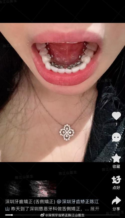 后牙舌侧倾斜正畸-图1