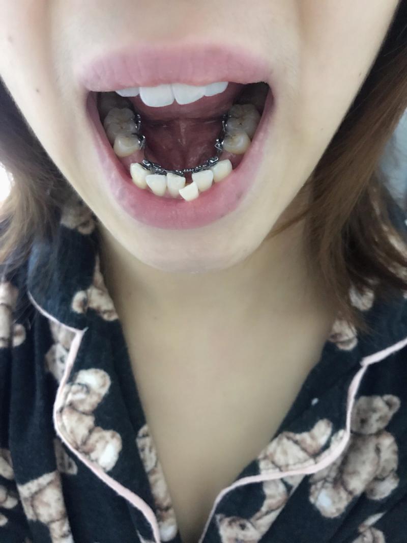 后牙舌侧倾斜正畸-图2