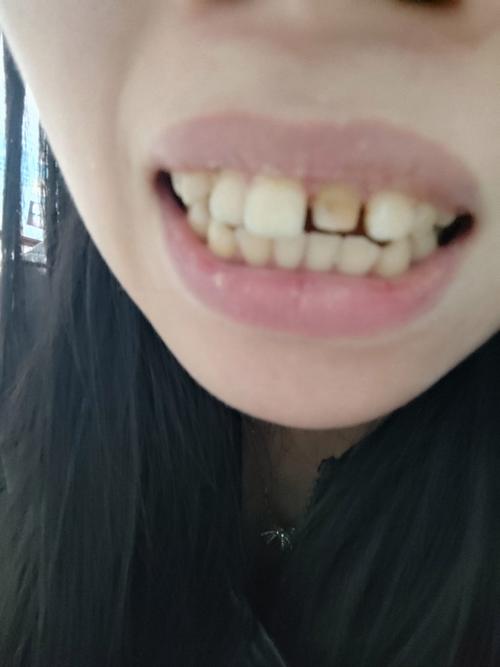 正畸后牙缝隙变大?原因何在?如何应对?-图2 正畸后牙缝隙变大?原因何在?如何应对?-图2