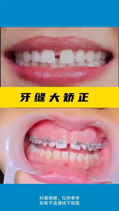 正畸后牙缝隙变大?原因何在?如何应对?-图3 正畸后牙缝隙变大?原因何在?如何应对?-图3