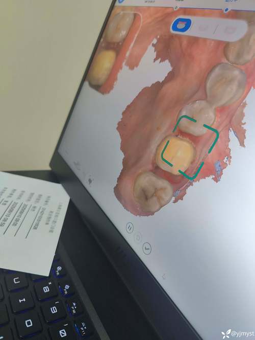 隐形正畸口扫几次-图1