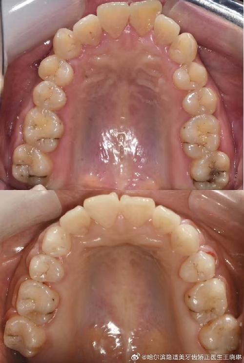正畸尖牙关系案例中，尖牙III类关系如何矫治？-图1