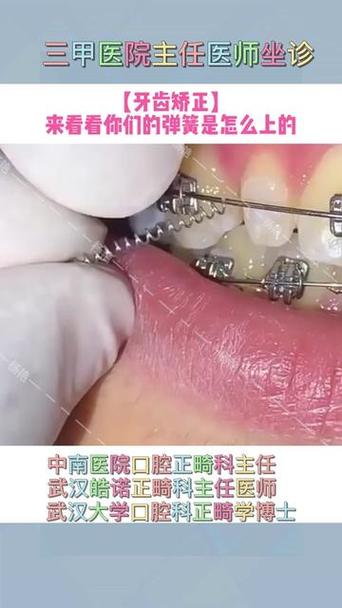 正畸牙齿上为何要加弹簧？作用原理是什么？-图3