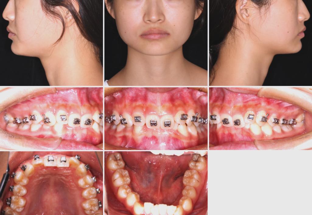 正畸安氏分类病例中，不同类型的临床特征与矫治策略差异？-图1