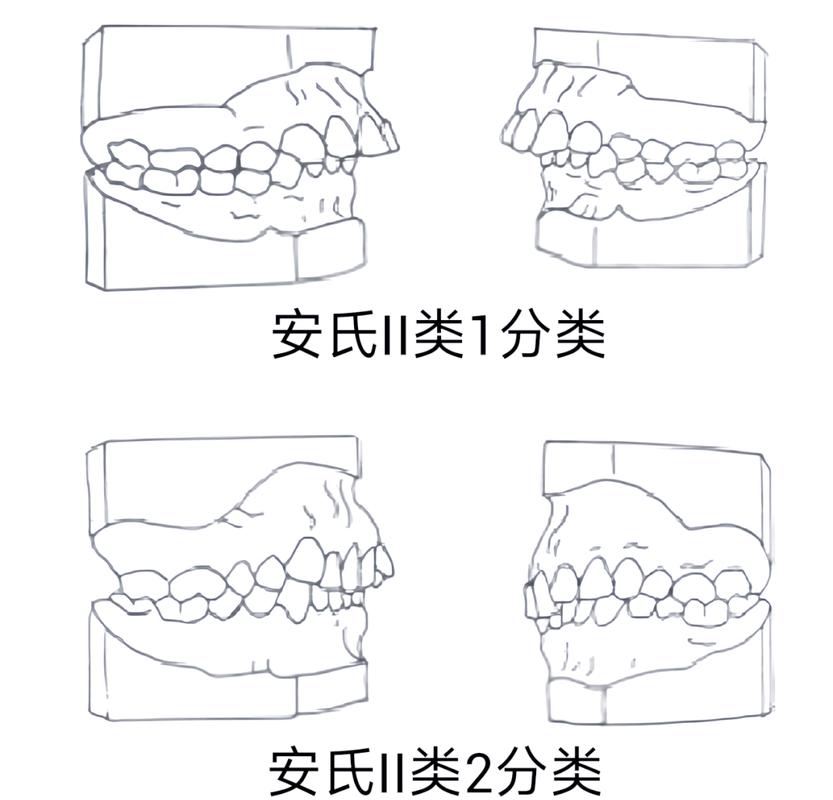 正畸安氏分类病例中，不同类型的临床特征与矫治策略差异？-图2