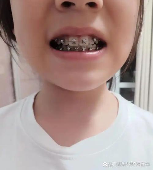 儿童龅牙看正畸科-图3