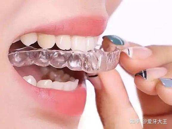 圣玛特正畸价格怎么样？值不值得做？-图1