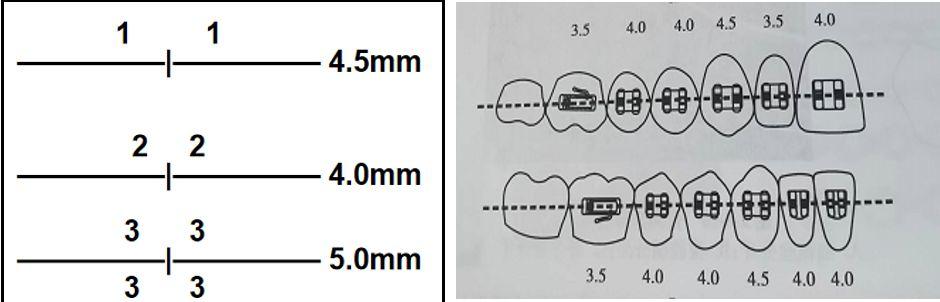 正畸托槽如何区分？材质外观功能看这里-图2