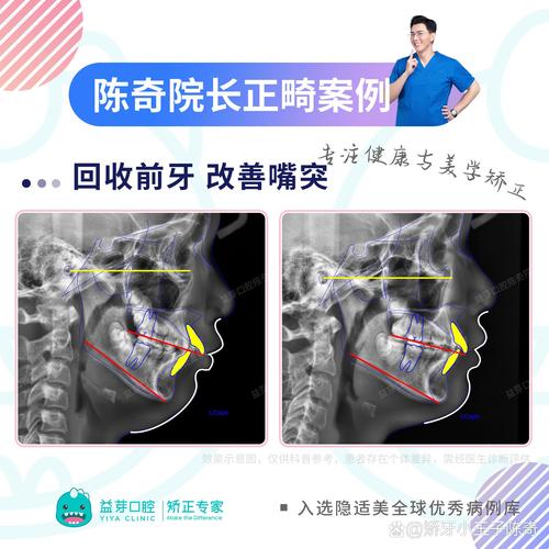 正畸和平面的控制-图3