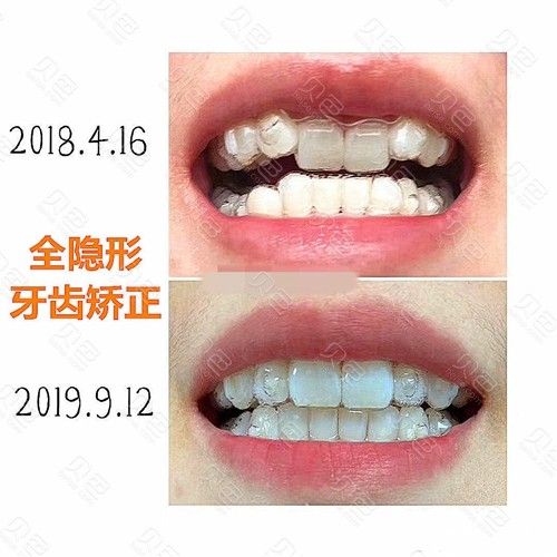 牙科诊所隐形正畸-图1