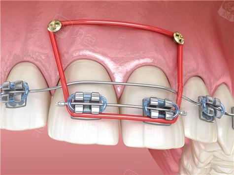 正畸支抗钉大小怎么选才合适?-图2 正畸支抗钉大小怎么选才合适?-图2