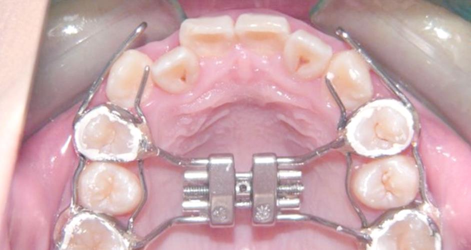 进口前牵装置正畸效果怎样？适合骨性畸形矫正吗？-图1