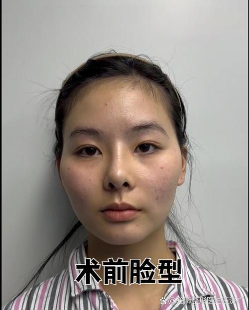 正畸会使颧骨变高-图2